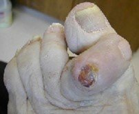 Hammertoe