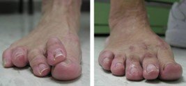 Hammertoe