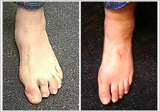 What Is Hammertoe, and How Can You Treat It? - GoodRx