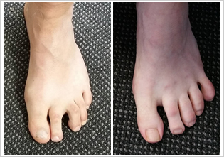 Toe Exercises After Hammertoe Surgery