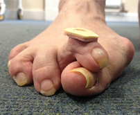 What Is Hammer Toe And How To Fix Them!