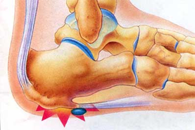 bone spur foot symptoms